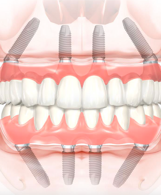 Modèle De Démonstration Dentaire All On 4 & All On 6 - Pour Formation Et Démo Implantologie - Mâchoire Supérieure